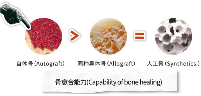 同种异体骨到底是什么？都给了谁用？